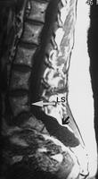 Ectasia dural Ectasia dural