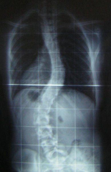 Escoliosis Escoliosis dorsal