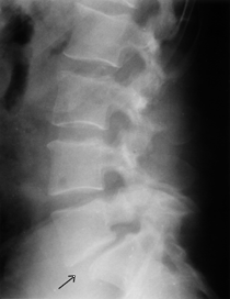 Espondilolistesis Espondilolistesis