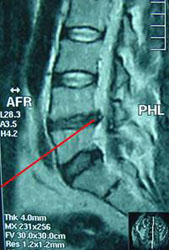 Hernia discal Hernia discal