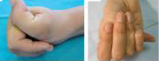 Laxitud articular laxitud