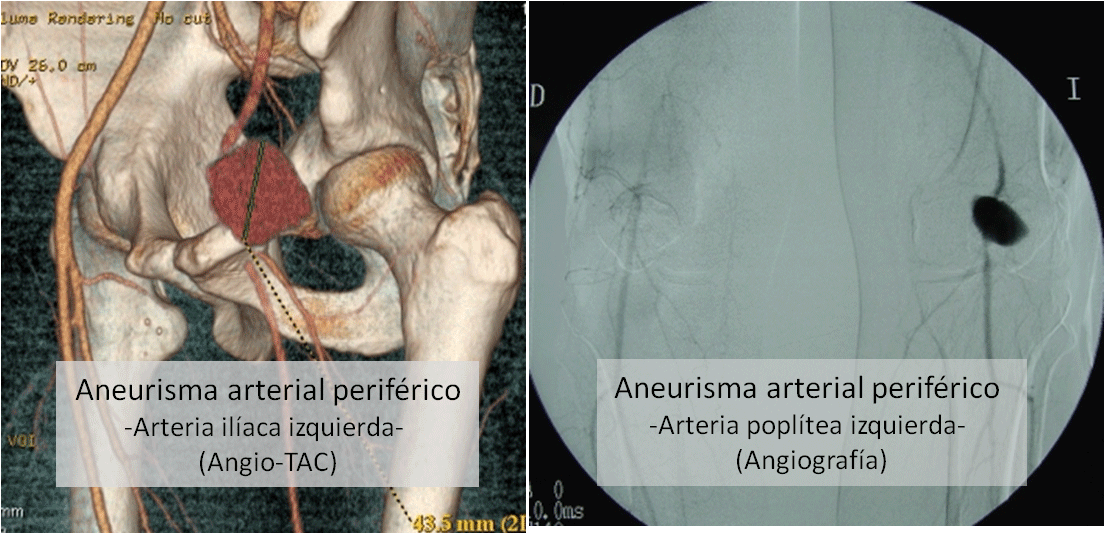 Aneurismas arteriales periféricos