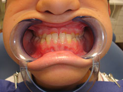 maloclusion-severax250_www.canalmarfan.org